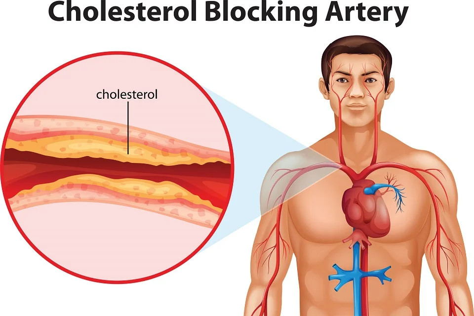 What is Cholesterol and Triglyceride? Ayurvedic diet for Cholesterol Control